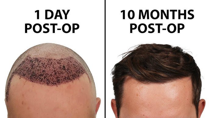 Before and After FUE Hair Transplant