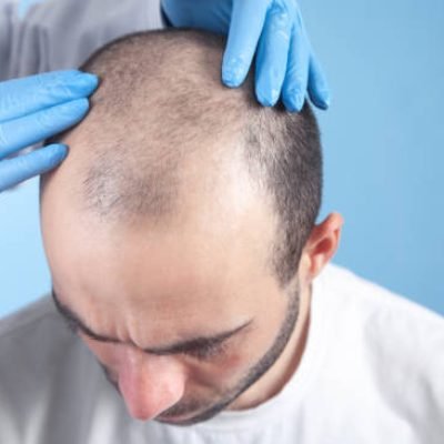 FUE Hair Transplant in Karachi